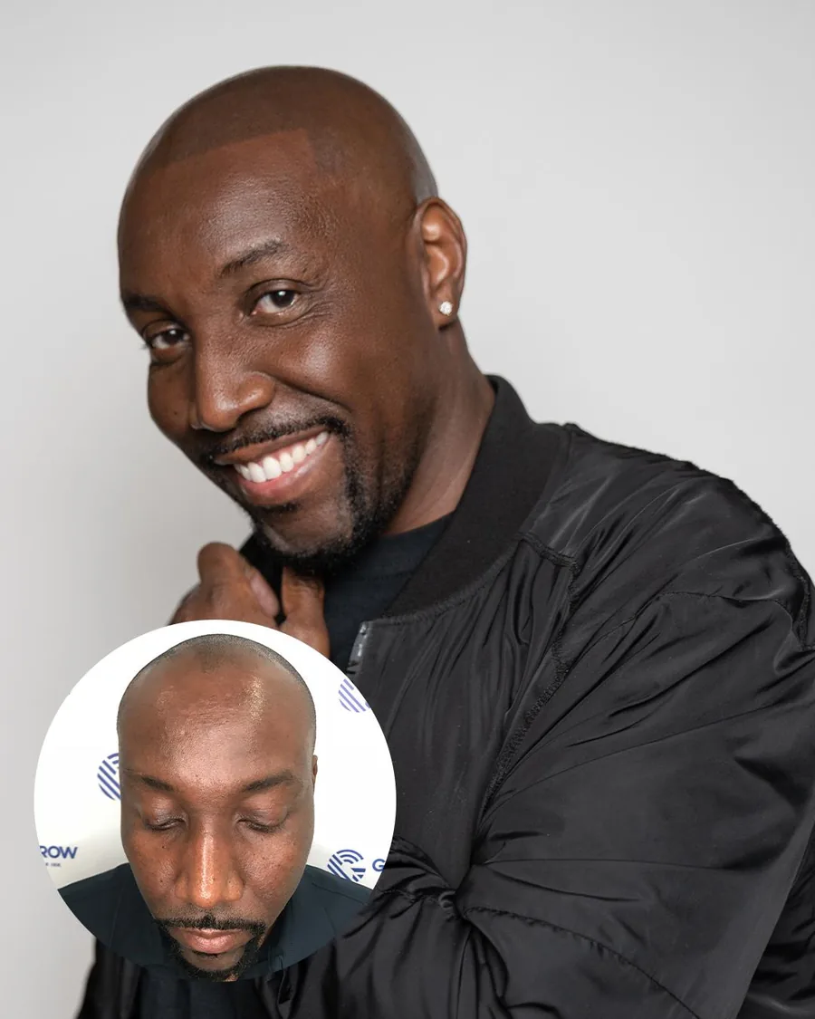 Scalp micropigmentation before and after at Erik Roberto SMP Studio